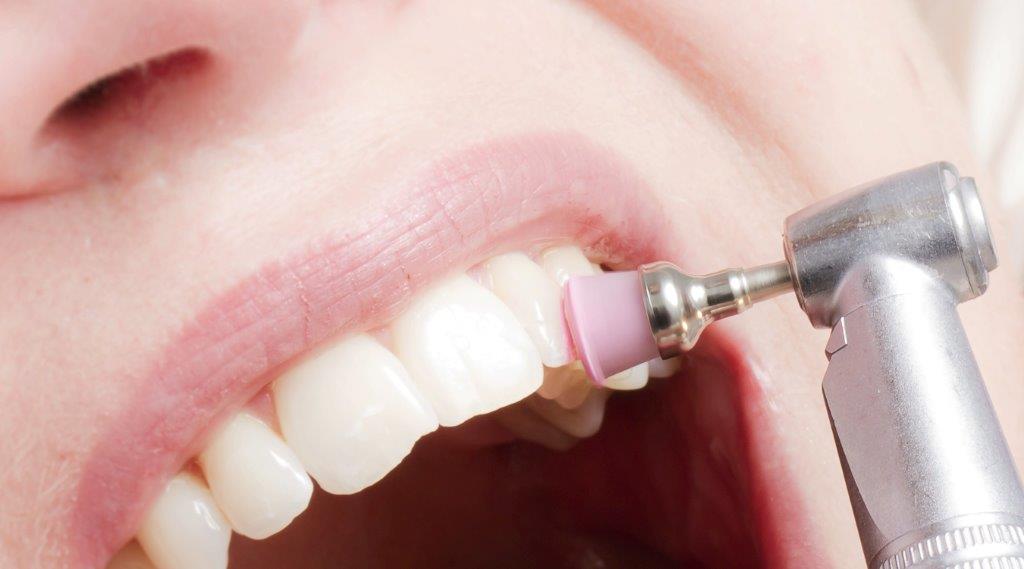 Rhone Dental Clinic Article Dental Prophylaxis